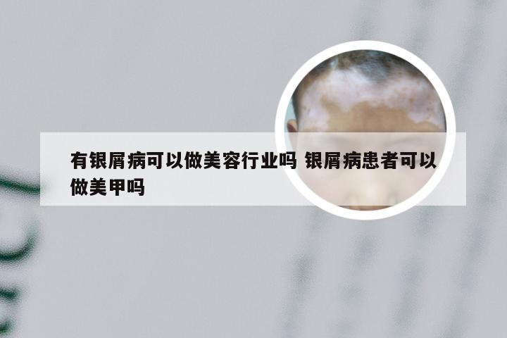 有银屑病可以做美容行业吗 银屑病患者可以做美甲吗