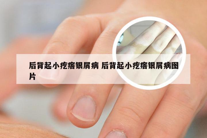 后背起小疙瘩银屑病 后背起小疙瘩银屑病图片