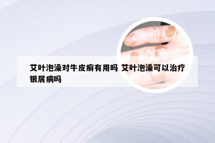 艾叶泡澡对牛皮癣有用吗 艾叶泡澡可以治疗银屑病吗