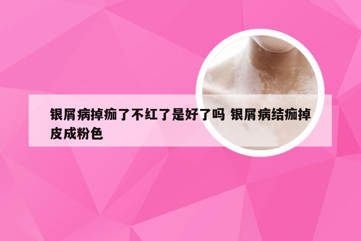 银屑病掉痂了不红了是好了吗 银屑病结痂掉皮成粉色