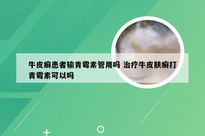 牛皮癣患者输青霉素管用吗 治疗牛皮肤癣打青霉素可以吗