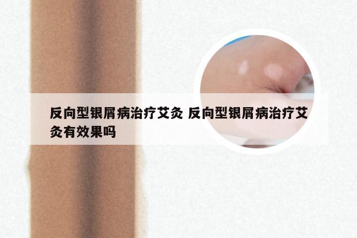 反向型银屑病治疗艾灸 反向型银屑病治疗艾灸有效果吗