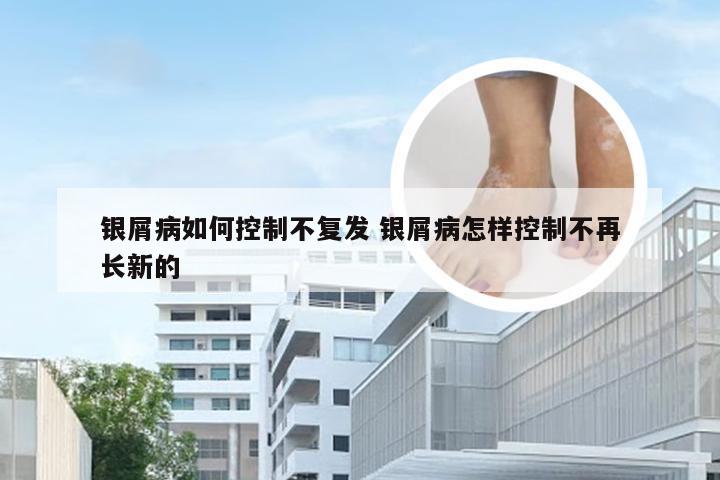 银屑病如何控制不复发 银屑病怎样控制不再长新的