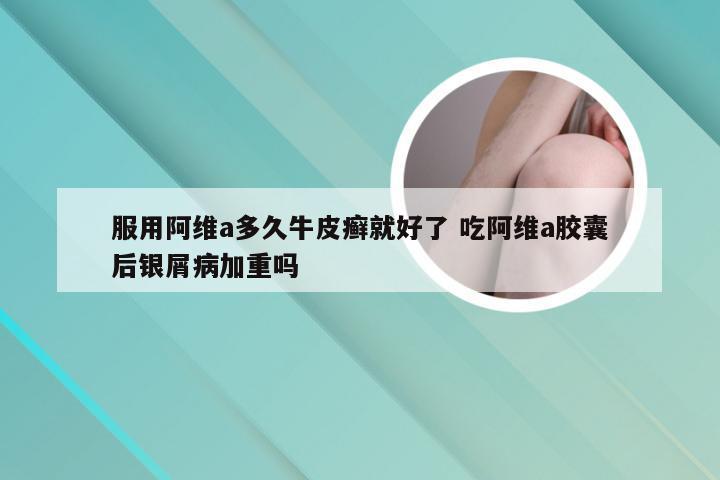 服用阿维a多久牛皮癣就好了 吃阿维a胶囊后银屑病加重吗