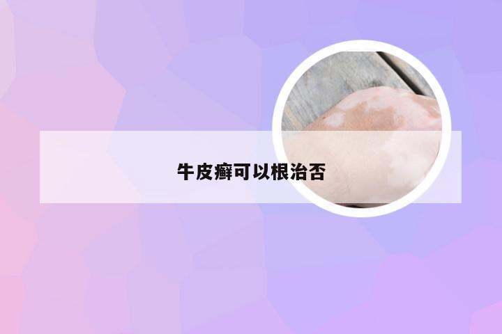 牛皮癣可以根治否