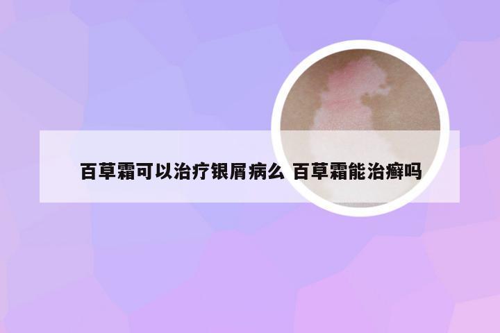 百草霜可以治疗银屑病么 百草霜能治癣吗