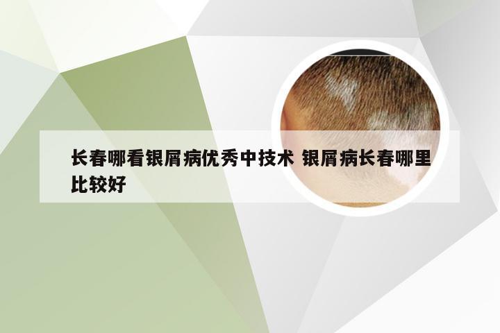 长春哪看银屑病优秀中技术 银屑病长春哪里比较好