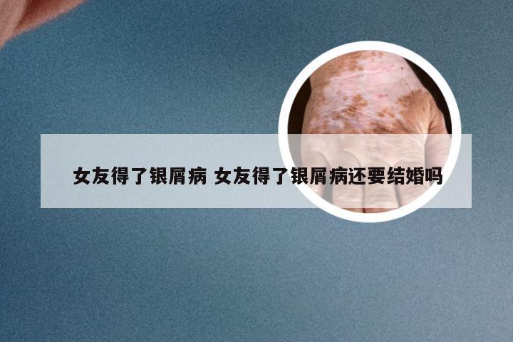 女友得了银屑病 女友得了银屑病还要结婚吗