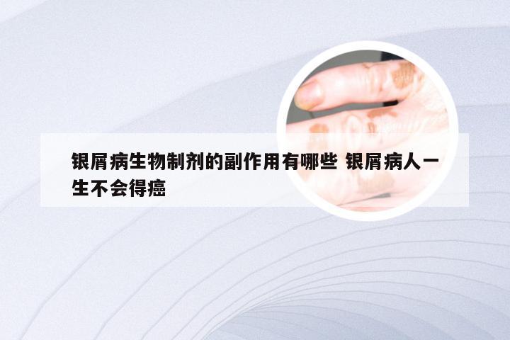 银屑病生物制剂的副作用有哪些 银屑病人一生不会得癌