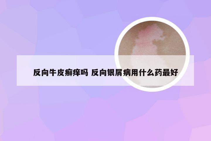 反向牛皮癣痒吗 反向银屑病用什么药最好