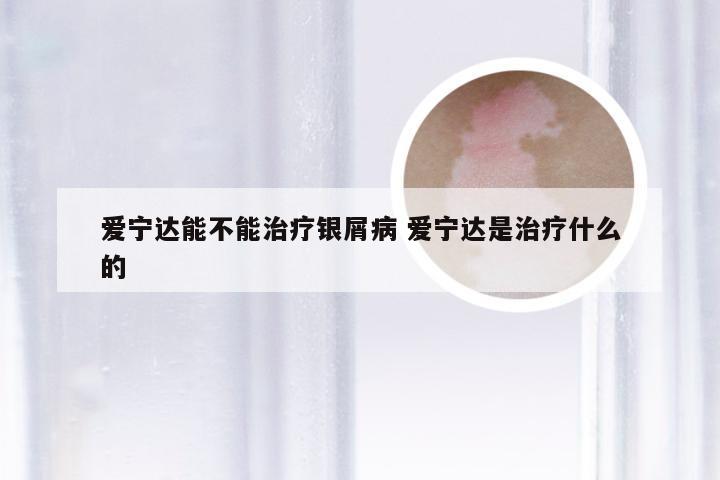 爱宁达能不能治疗银屑病 爱宁达是治疗什么的