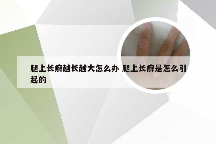 腿上长癣越长越大怎么办 腿上长癣是怎么引起的