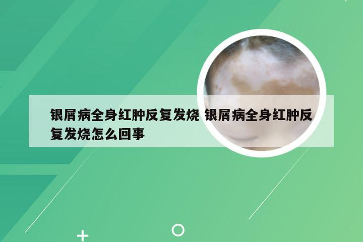 银屑病全身红肿反复发烧 银屑病全身红肿反复发烧怎么回事