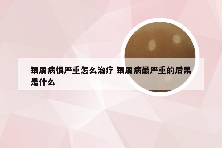 银屑病很严重怎么治疗 银屑病最严重的后果是什么