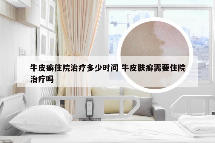 牛皮癣住院治疗多少时间 牛皮肤癣需要住院治疗吗