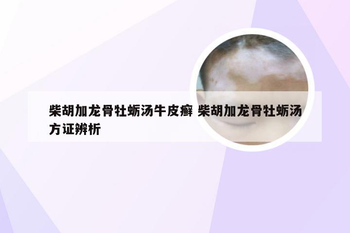 柴胡加龙骨牡蛎汤牛皮癣 柴胡加龙骨牡蛎汤方证辨析