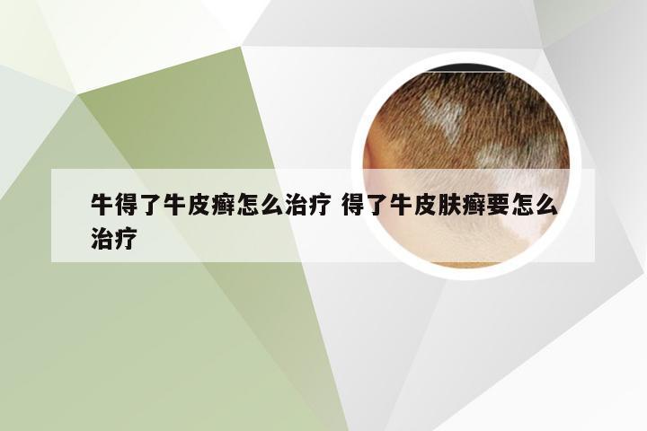 牛得了牛皮癣怎么治疗 得了牛皮肤癣要怎么治疗