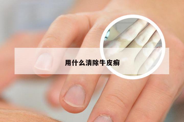 用什么清除牛皮癣