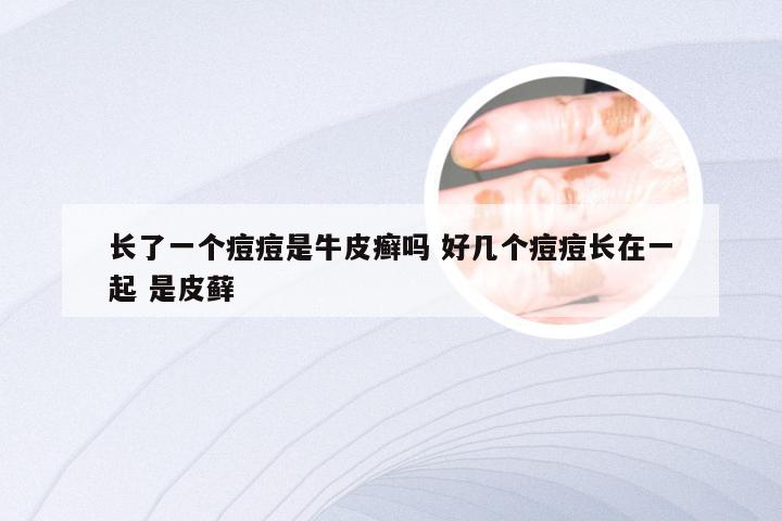 长了一个痘痘是牛皮癣吗 好几个痘痘长在一起 是皮藓