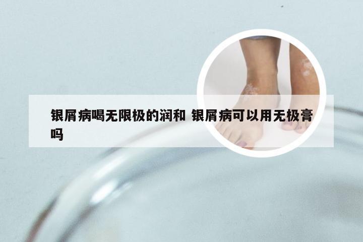 银屑病喝无限极的润和 银屑病可以用无极膏吗