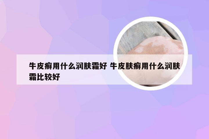 牛皮癣用什么润肤霜好 牛皮肤癣用什么润肤霜比较好