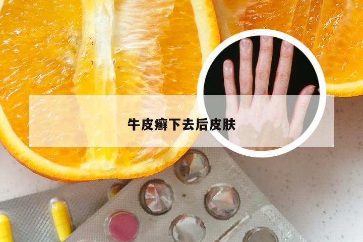 牛皮癣下去后皮肤