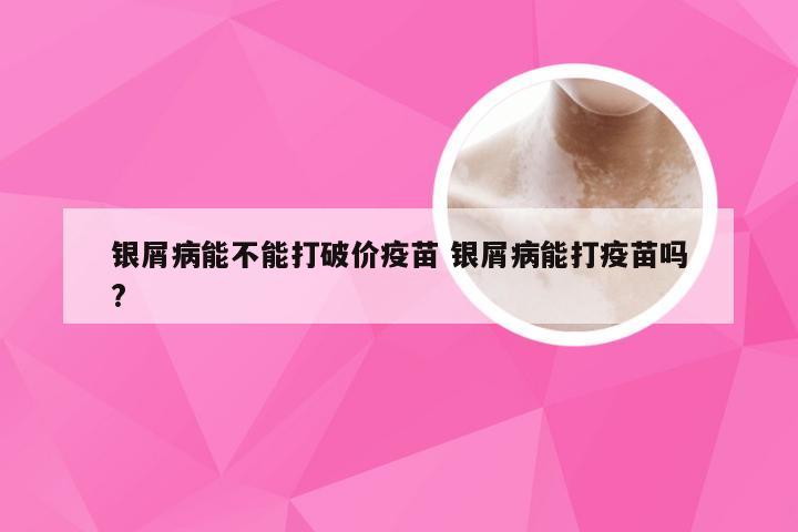 银屑病能不能打破价疫苗 银屑病能打疫苗吗?