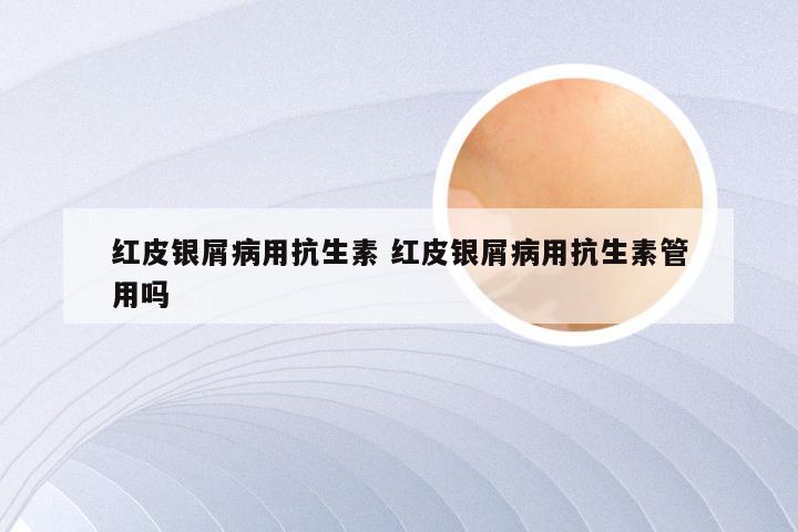 红皮银屑病用抗生素 红皮银屑病用抗生素管用吗