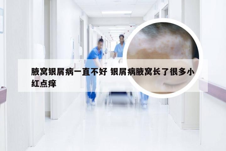 腋窝银屑病一直不好 银屑病腋窝长了很多小红点痒