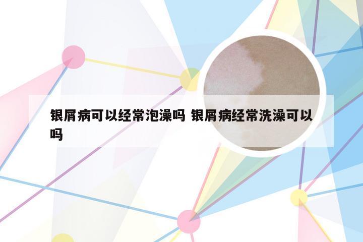 银屑病可以经常泡澡吗 银屑病经常洗澡可以吗