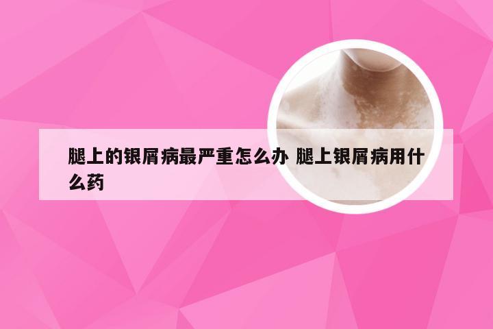 腿上的银屑病最严重怎么办 腿上银屑病用什么药