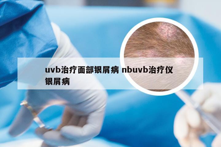 uvb治疗面部银屑病 nbuvb治疗仪 银屑病