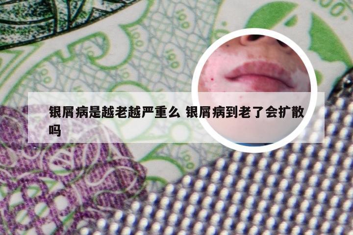 银屑病是越老越严重么 银屑病到老了会扩散吗