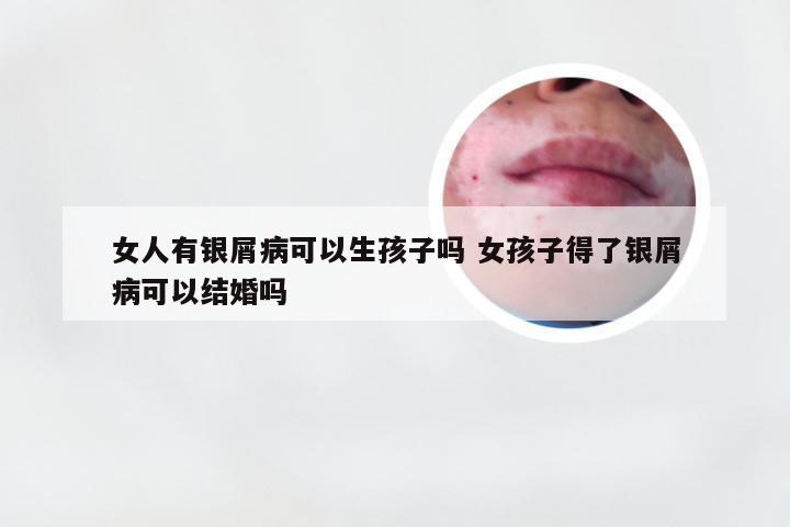 女人有银屑病可以生孩子吗 女孩子得了银屑病可以结婚吗