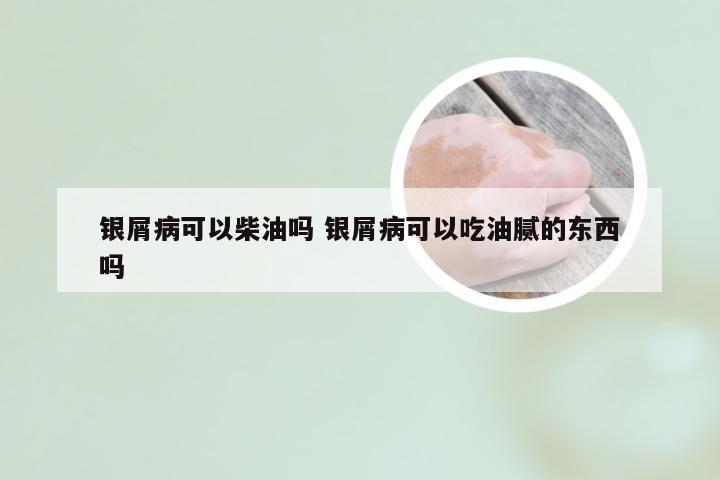 银屑病可以柴油吗 银屑病可以吃油腻的东西吗