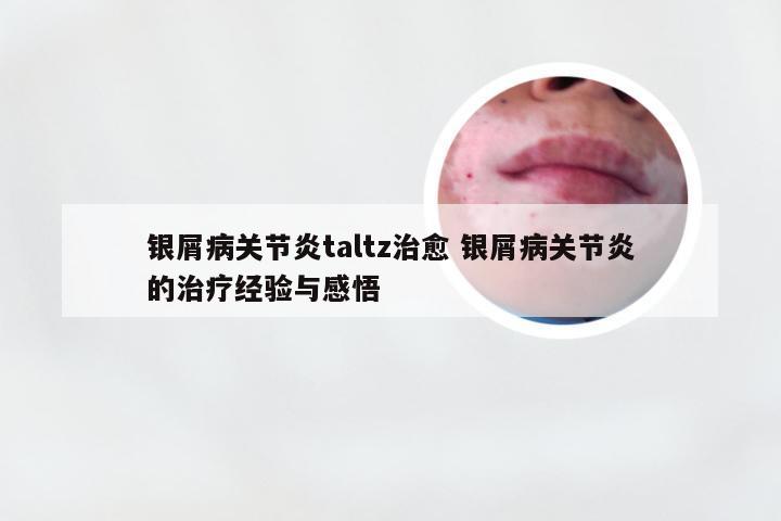 银屑病关节炎taltz治愈 银屑病关节炎的治疗经验与感悟