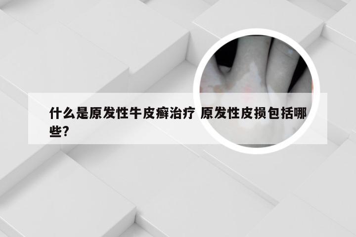 什么是原发性牛皮癣治疗 原发性皮损包括哪些?