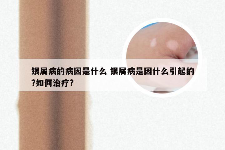 银屑病的病因是什么 银屑病是因什么引起的?如何治疗?