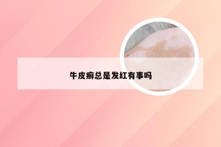 牛皮癣总是发红有事吗