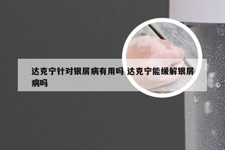 达克宁针对银屑病有用吗 达克宁能缓解银屑病吗