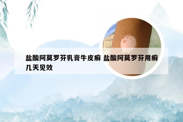 盐酸阿莫罗芬乳膏牛皮癣 盐酸阿莫罗芬用癣几天见效