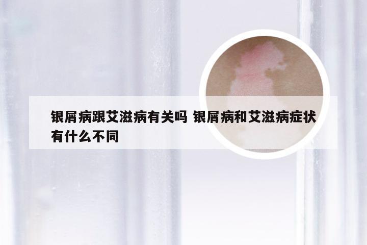 银屑病跟艾滋病有关吗 银屑病和艾滋病症状有什么不同