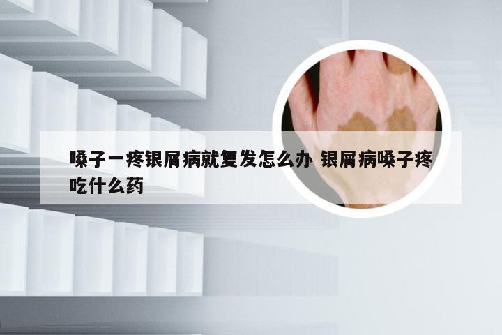 嗓子一疼银屑病就复发怎么办 银屑病嗓子疼吃什么药