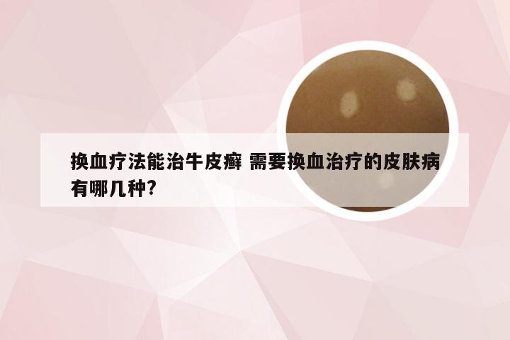 换血疗法能治牛皮癣 需要换血治疗的皮肤病有哪几种?