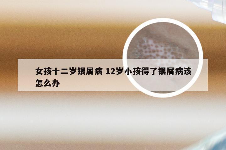 女孩十二岁银屑病 12岁小孩得了银屑病该怎么办