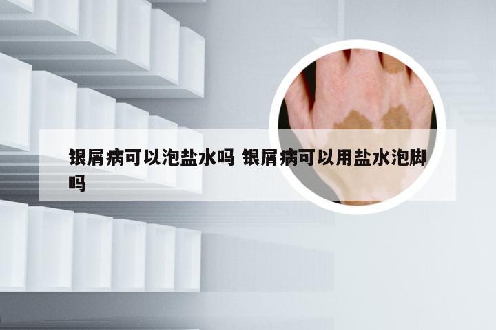 银屑病可以泡盐水吗 银屑病可以用盐水泡脚吗