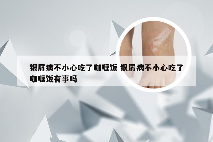 银屑病不小心吃了咖喱饭 银屑病不小心吃了咖喱饭有事吗