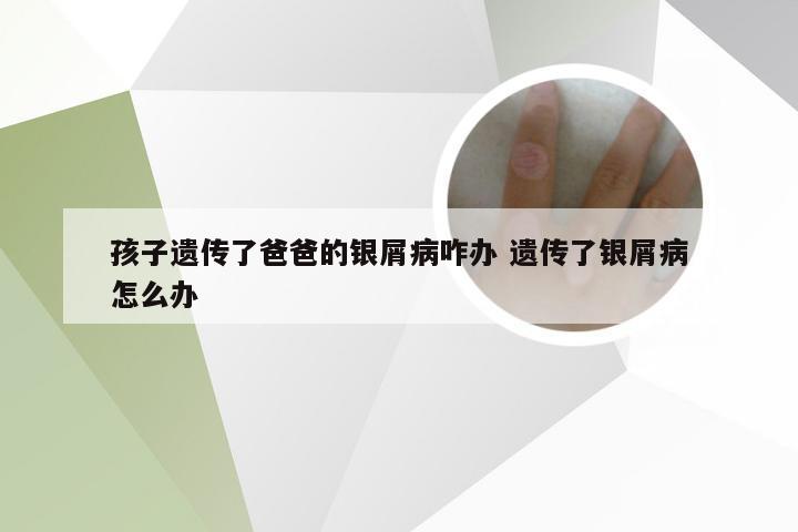 孩子遗传了爸爸的银屑病咋办 遗传了银屑病怎么办