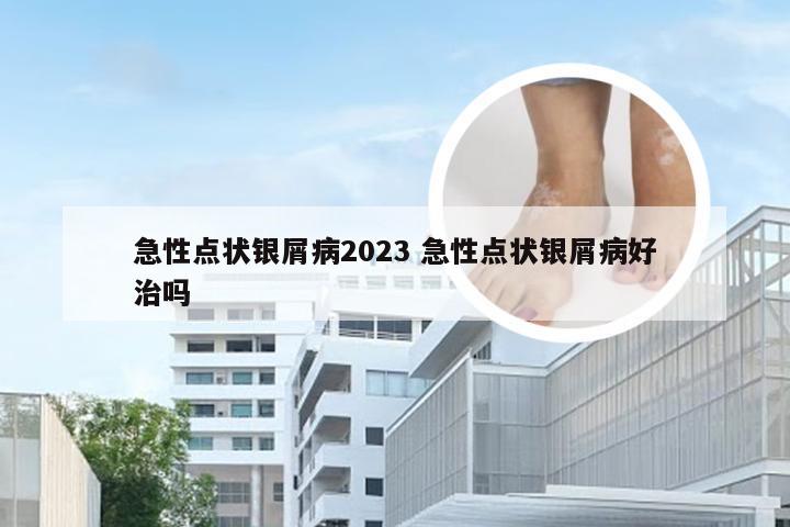 急性点状银屑病2023 急性点状银屑病好治吗