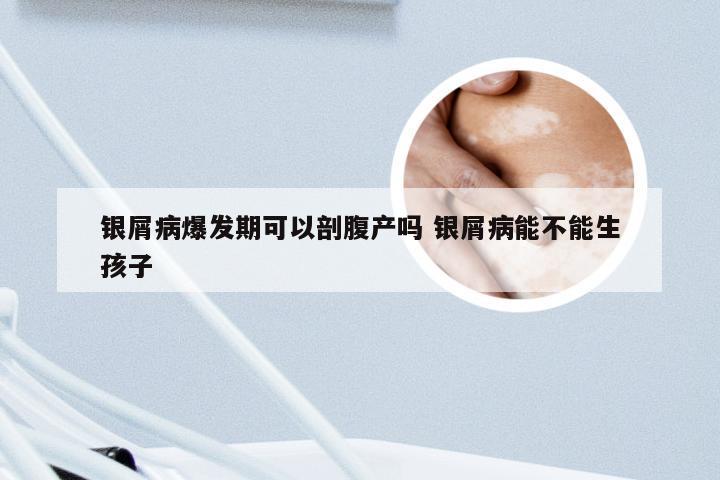 银屑病爆发期可以剖腹产吗 银屑病能不能生孩子